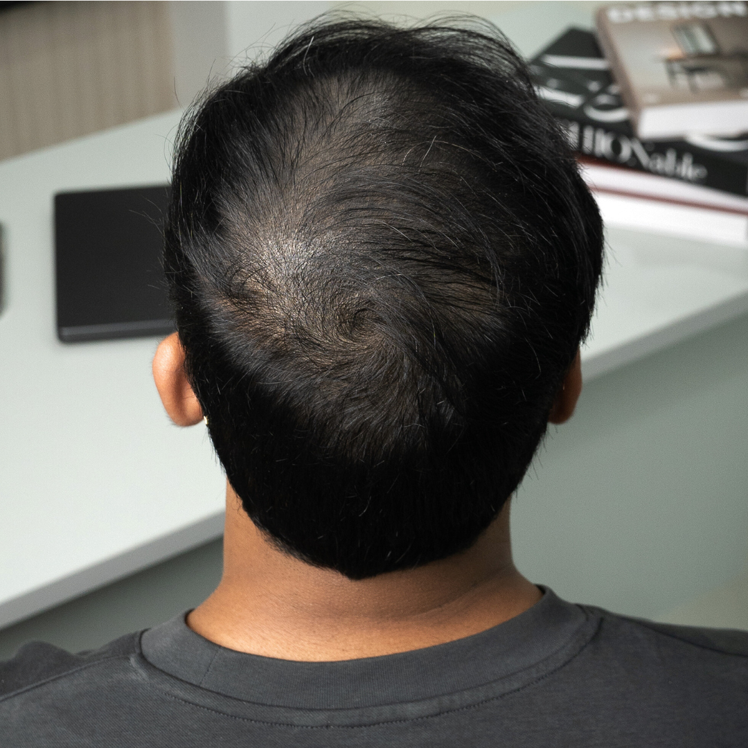 Apply Directly To Scalp
